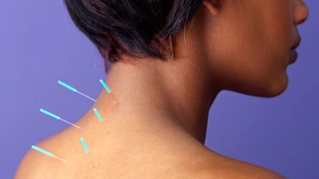 Lists of startling health benefits of Acupuncture