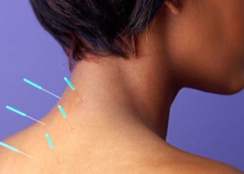 Lists of startling health benefits of Acupuncture